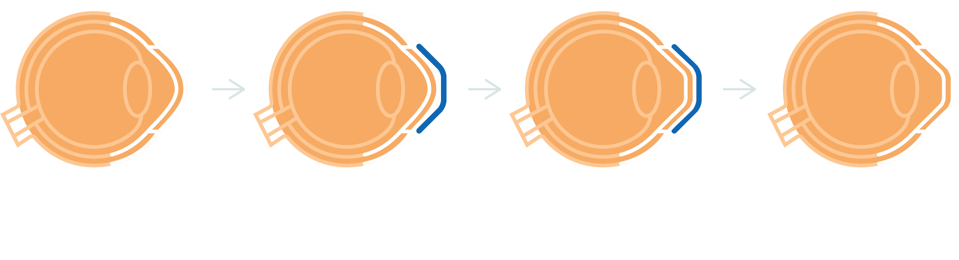 Ortho K myopia control contact lenses