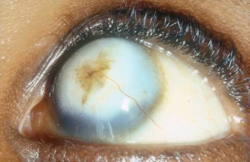 scarred corneal tissues